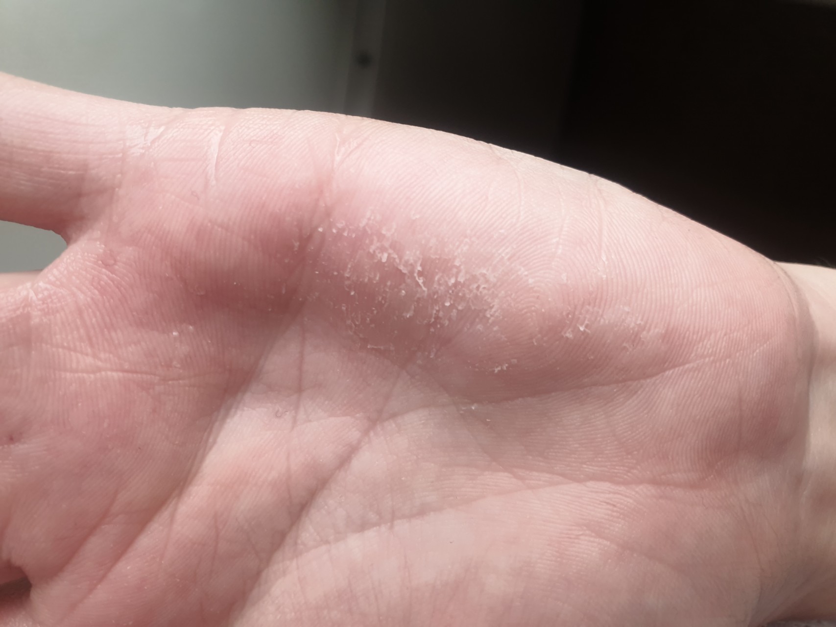 Сухая кожа рук: каких витаминов не хватает при шелушении кожи