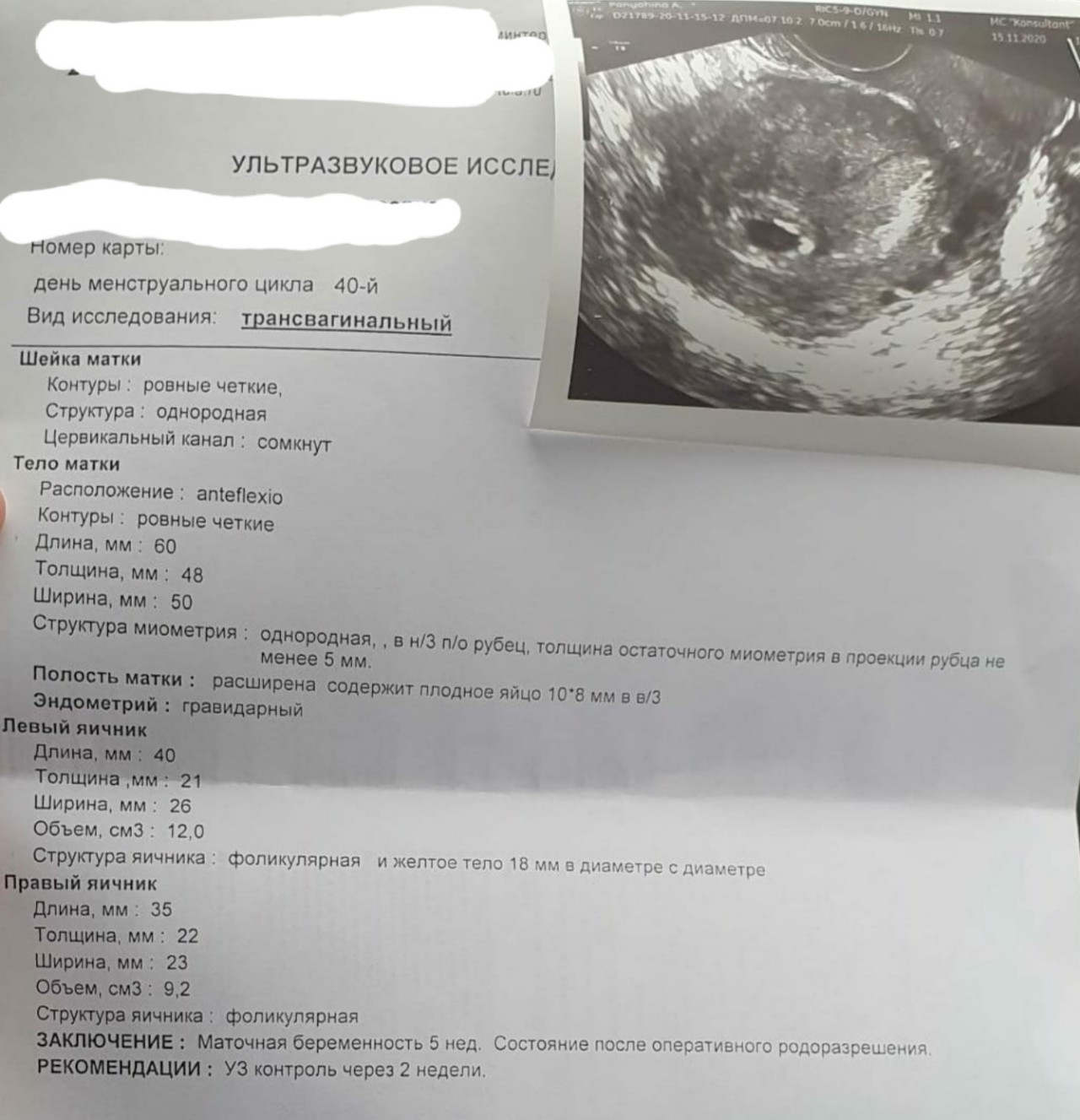 Фото узи 5 недель беременности с подробным описанием