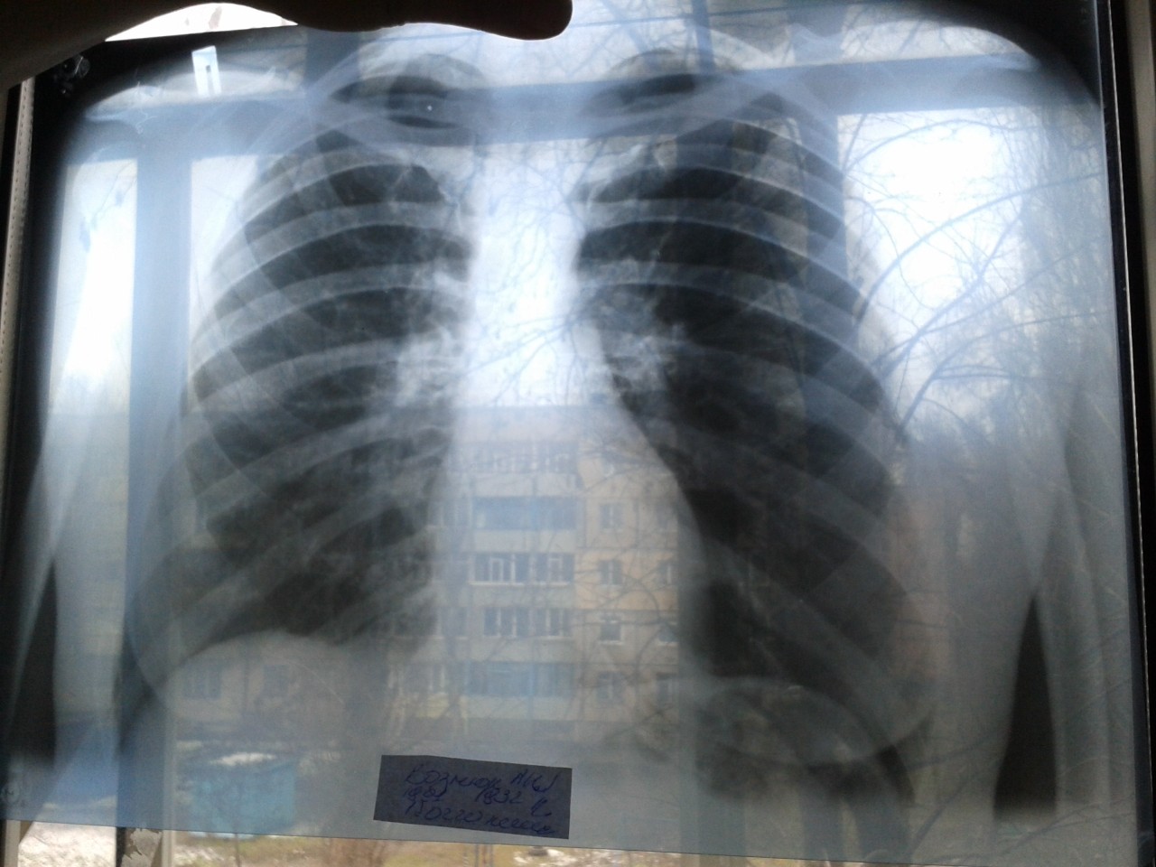 2х сторонняя пневмония рентген