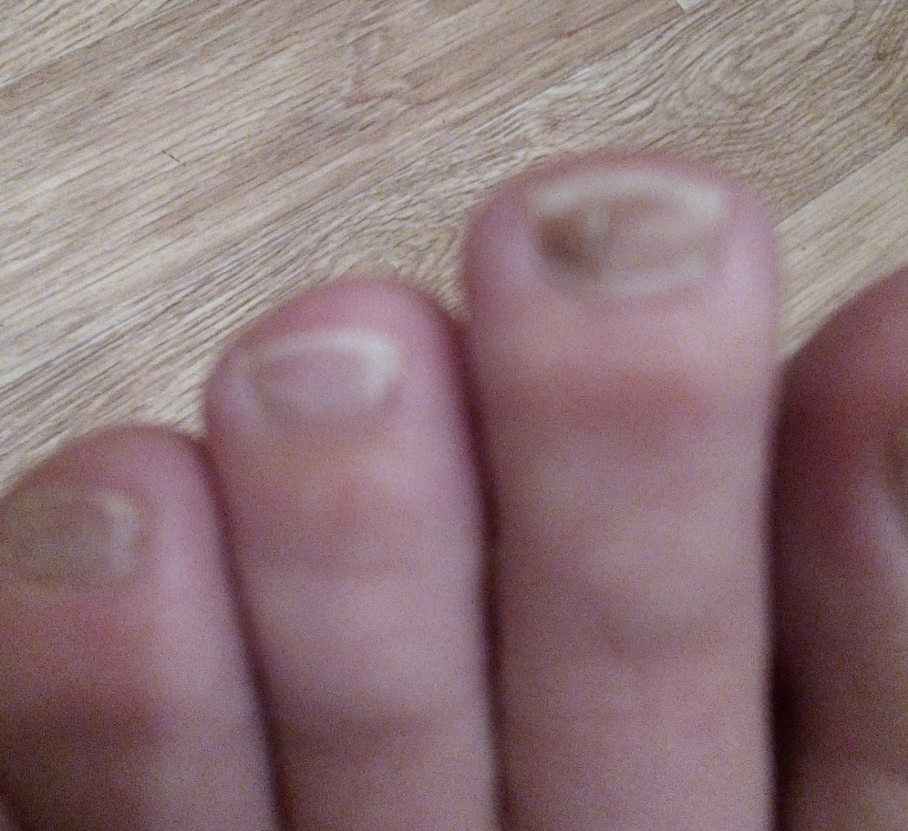 Фото пальца без ногтя на ноге