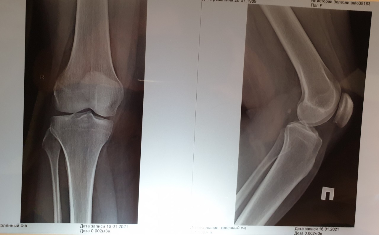 Рентген колена. Синостоз коленного сустава рентген. Рентген колена норма.