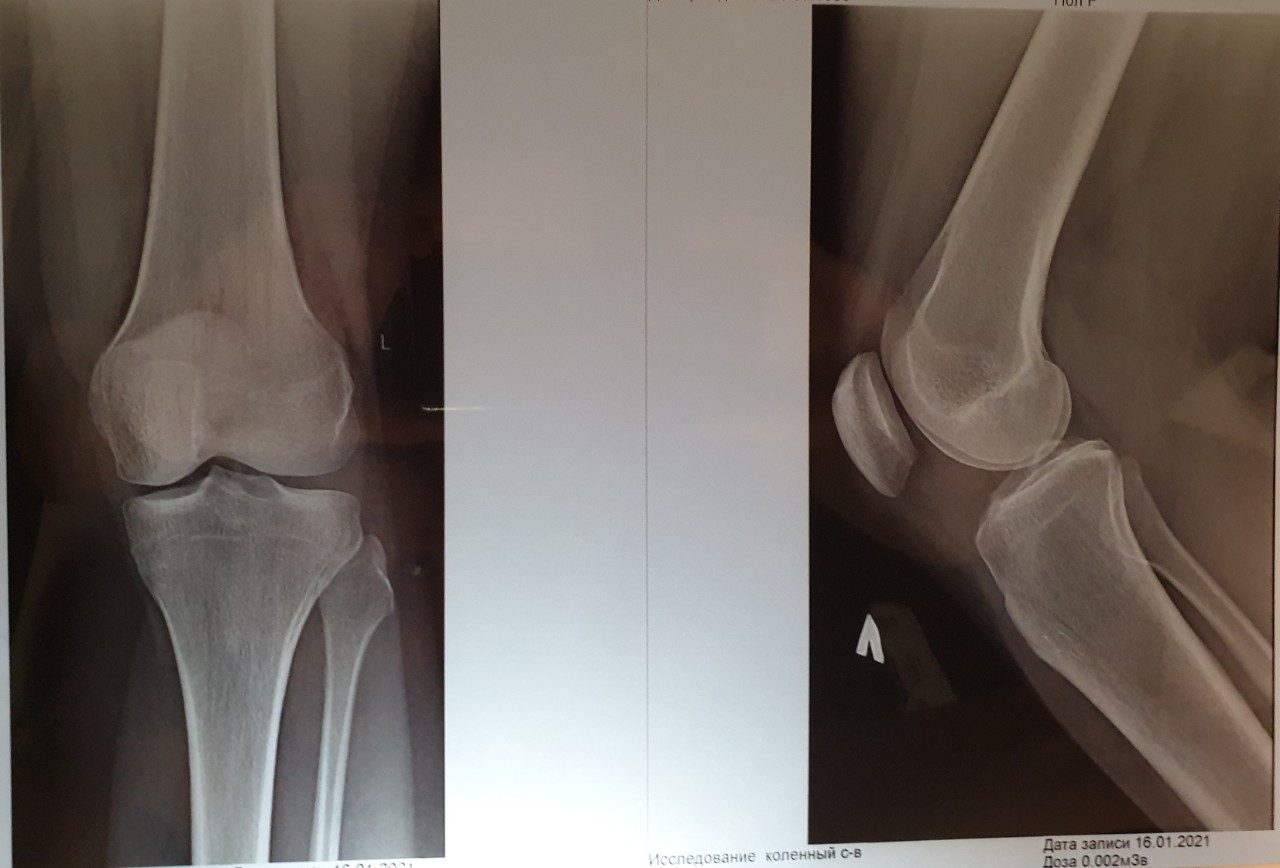Рентген колена. Пателлофеморальный артроз коленного сустава рентген. Остеопойкилия коленного сустава рентген.