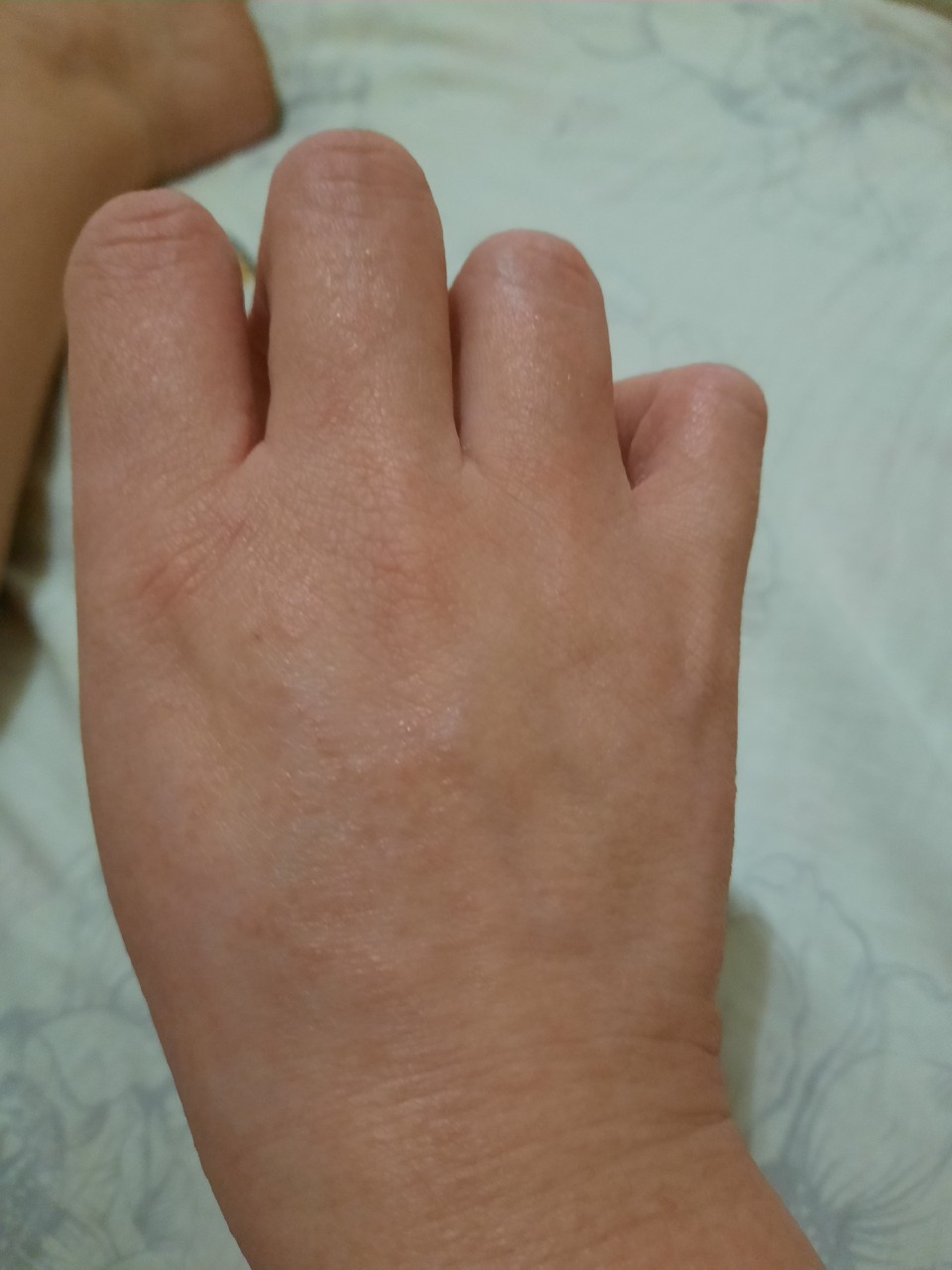 Сыпь на руках аллергическая руках