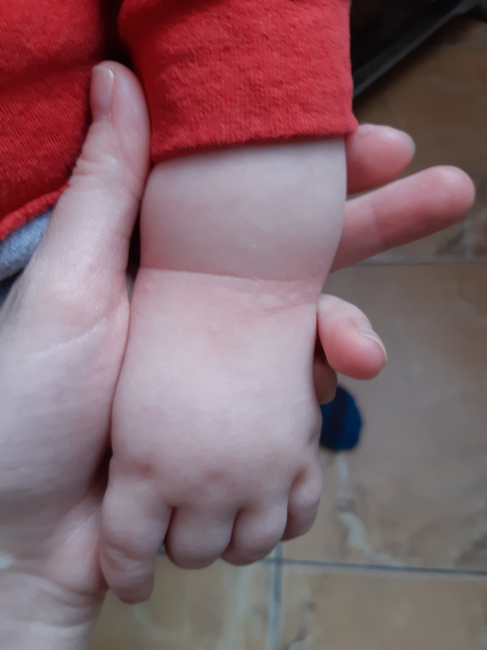 Обсыпаны руки у ребенка причины