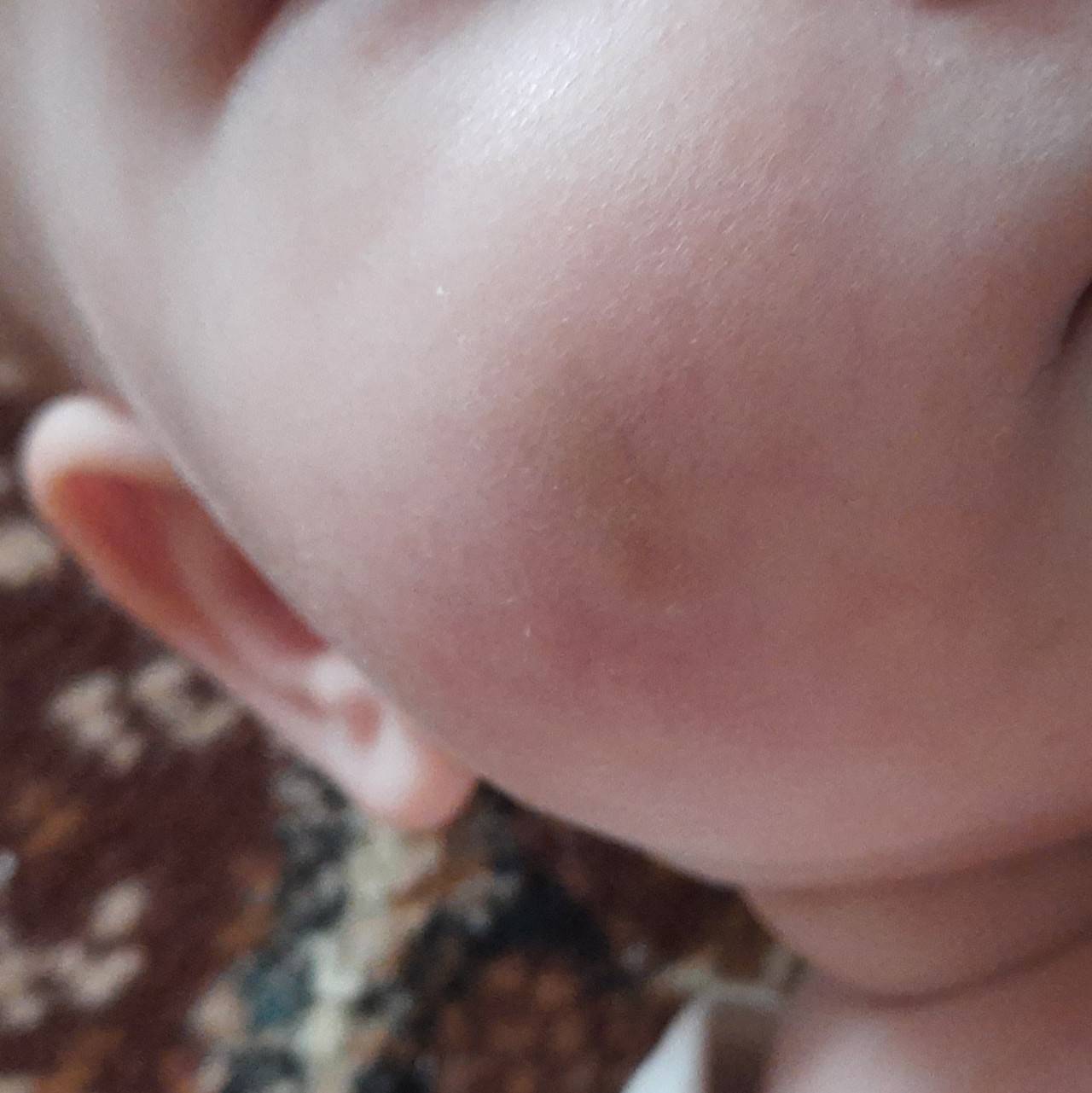 Обморожение щек у младенца