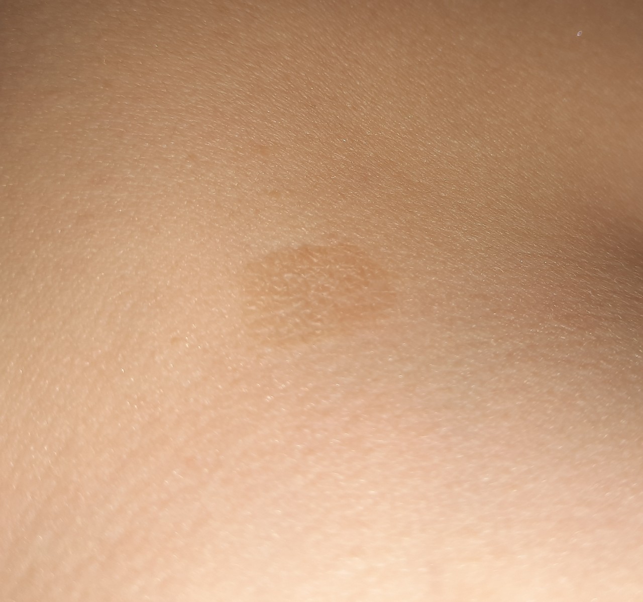 коричневые пятна на груди беременность фото 107