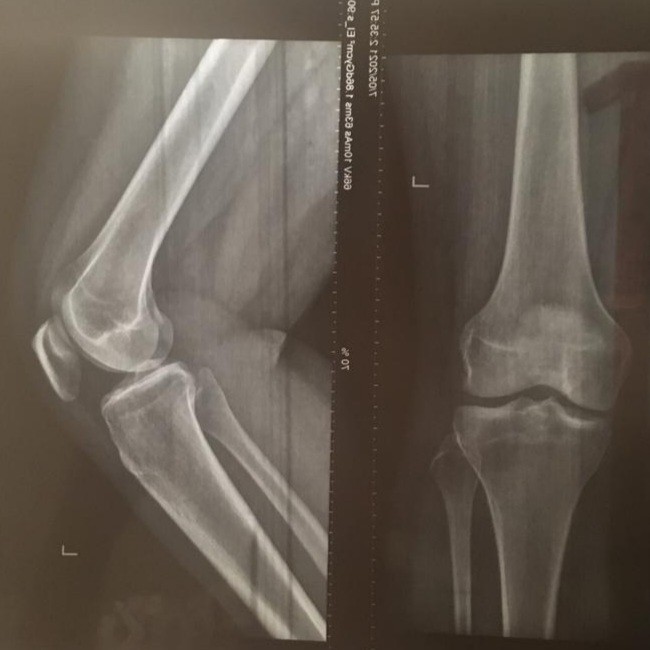 Рентген колена. Рентгенограмма коленного сустава в норме. Коленный сустав рентген норма. Мульпартита рентген коленного. Рентген коленного сустава норма и патология.