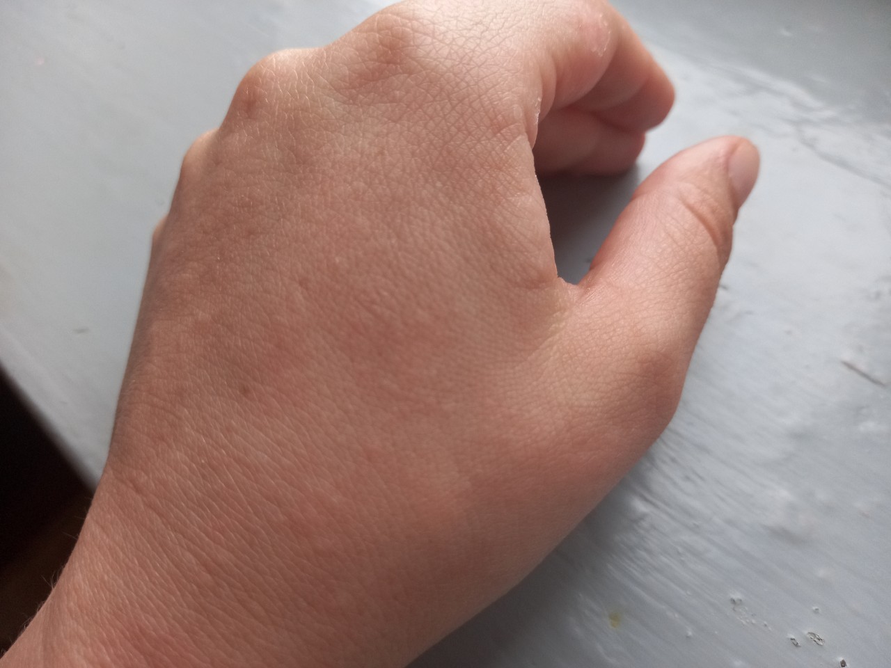 Сыпь на руке между большим и указательным пальцем