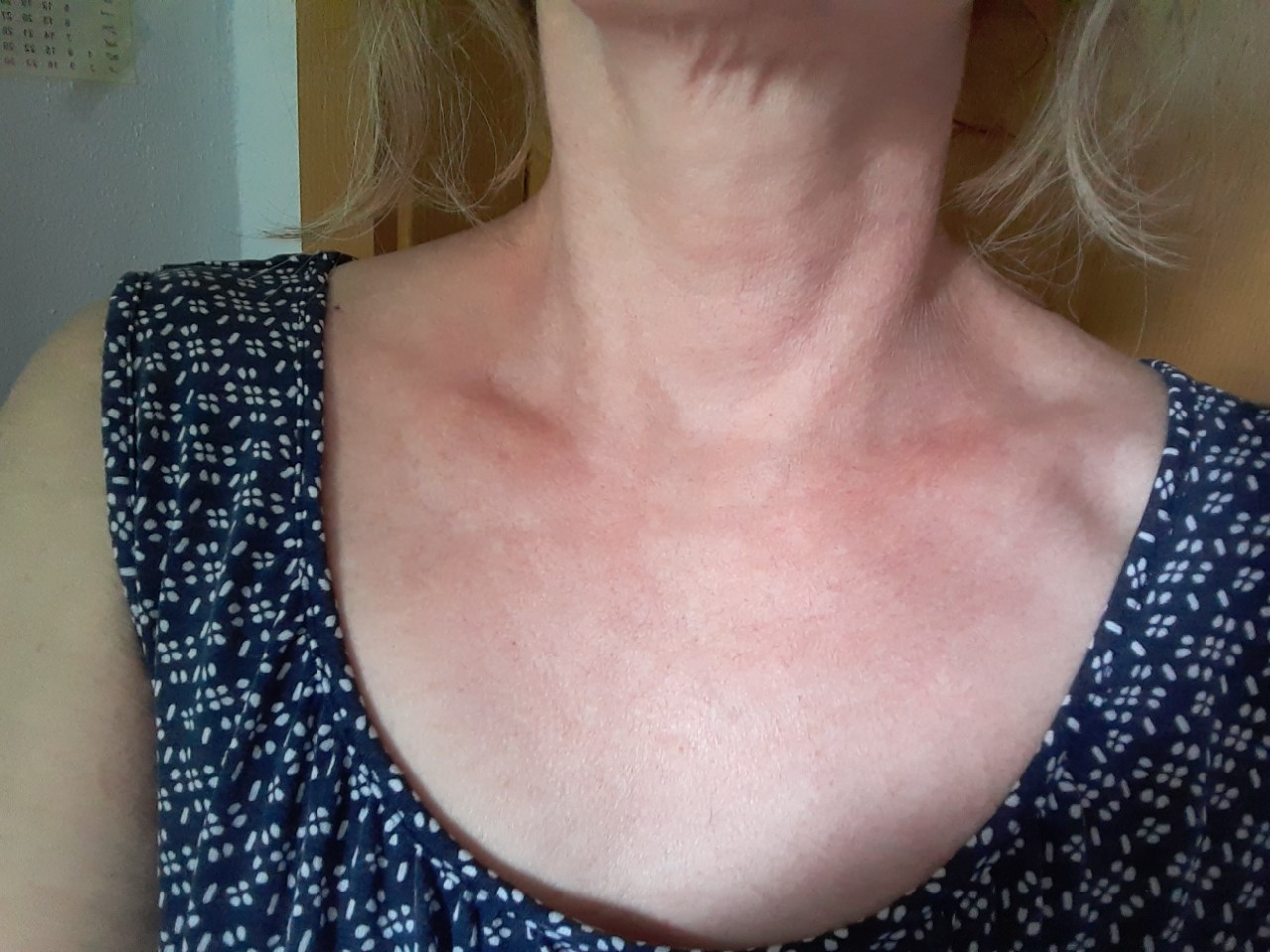 покраснение кожи на груди у женщин фото 111