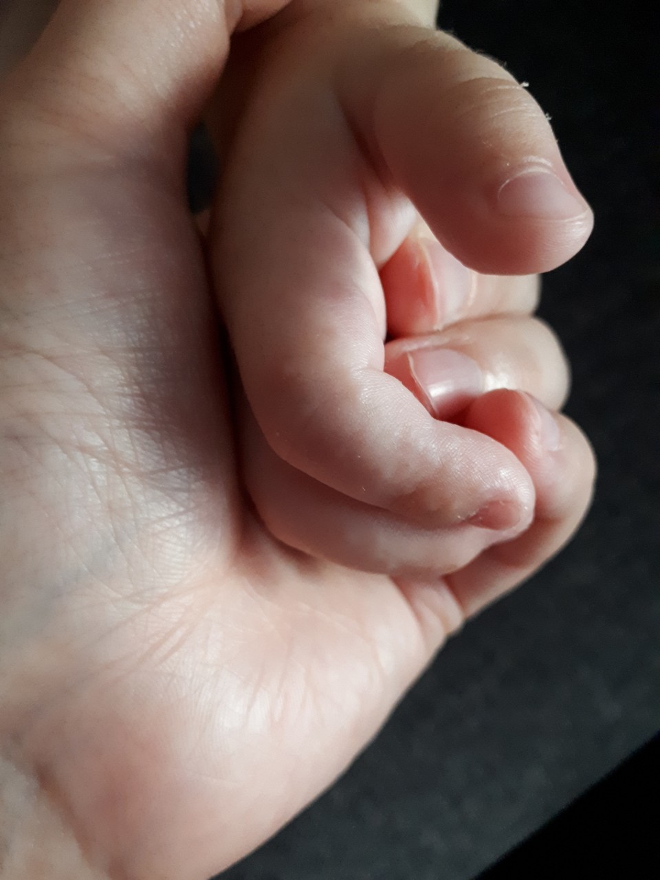 6 пальцев на руках у детей. Дисгидротическая экзема на пальцах. Экзема у малышей на пальце руки. Дисгидротическая экзема на пальцах у ребенка.