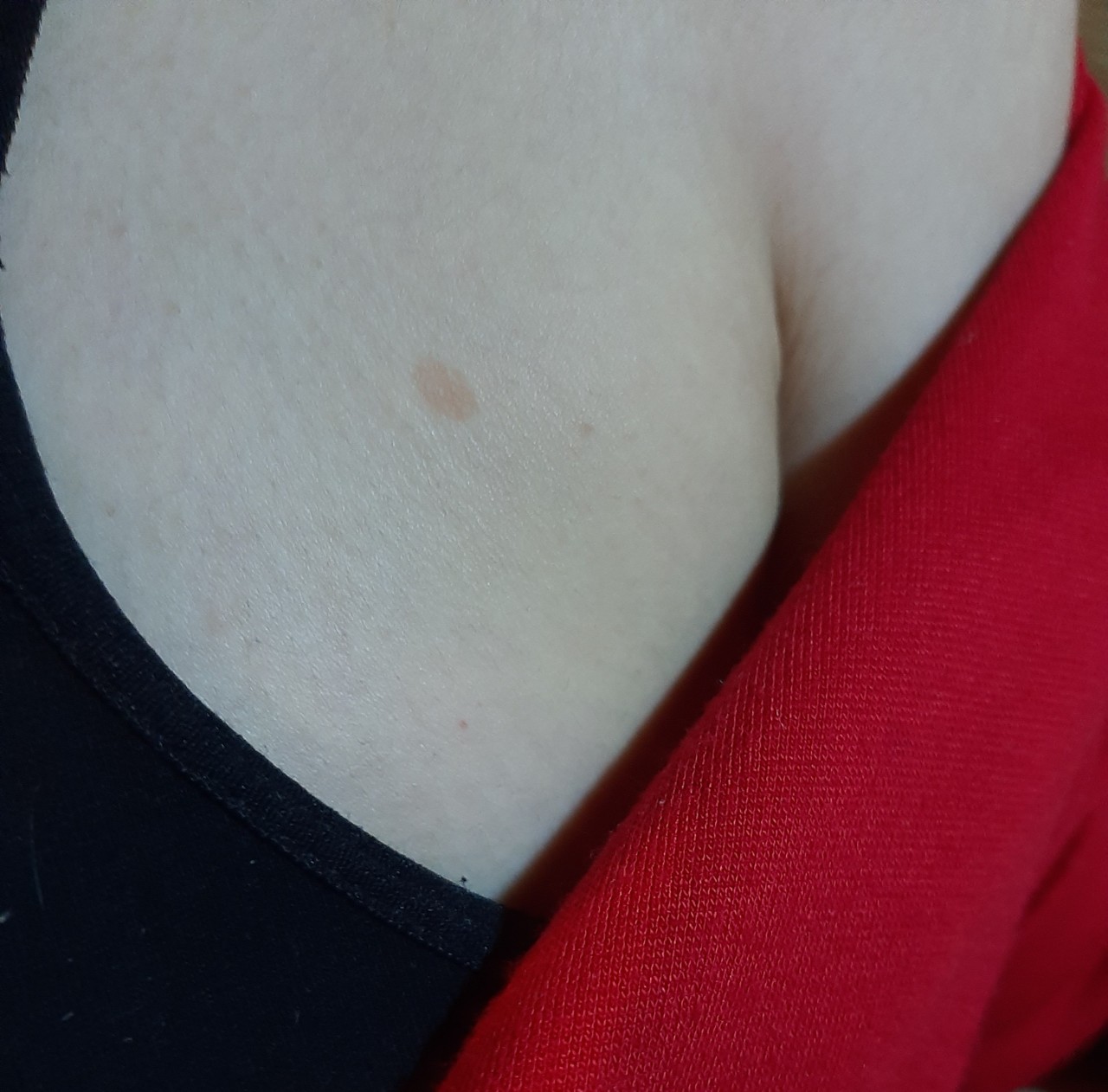 светлые пятна на груди женщин фото 37