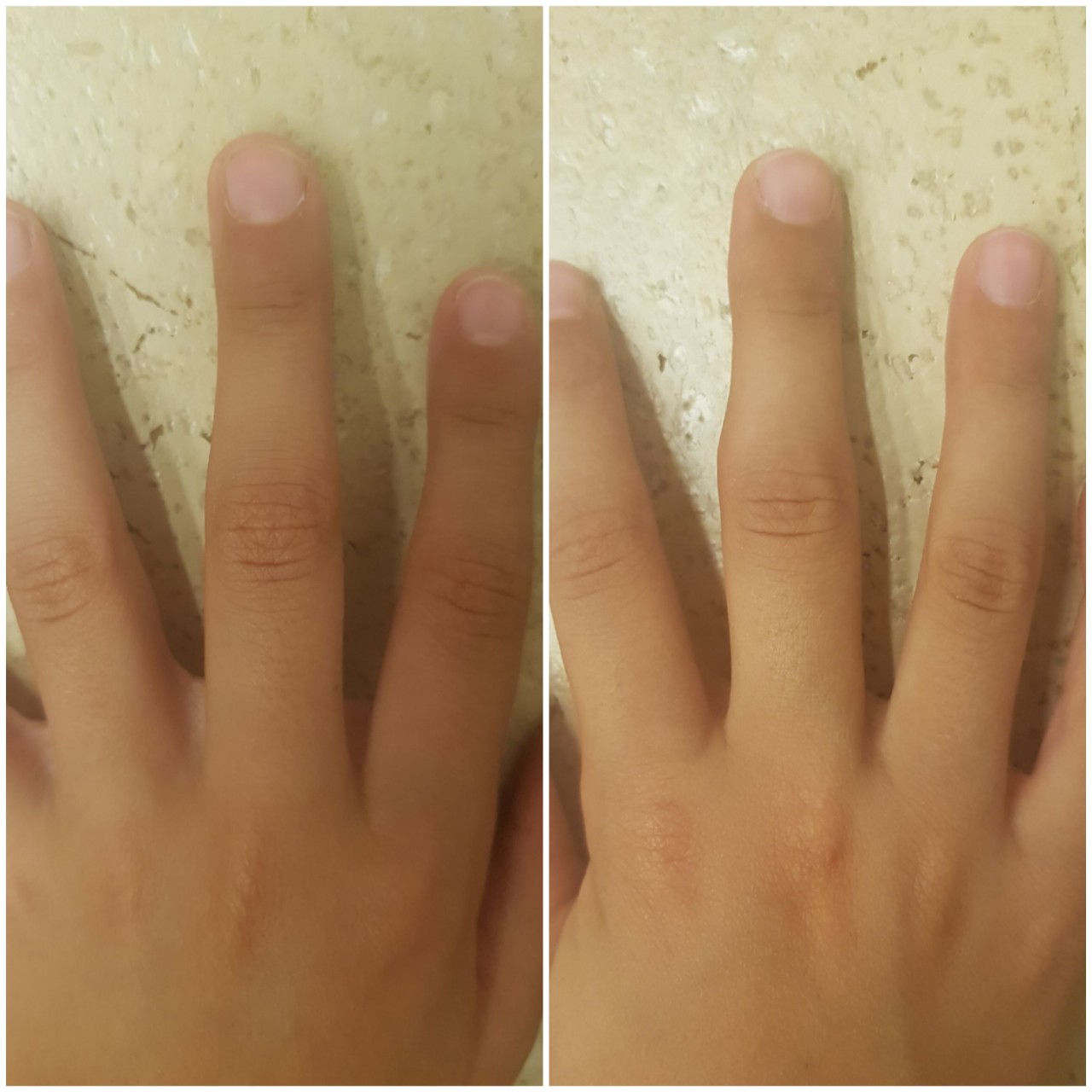 перелом безымянного пальца фото