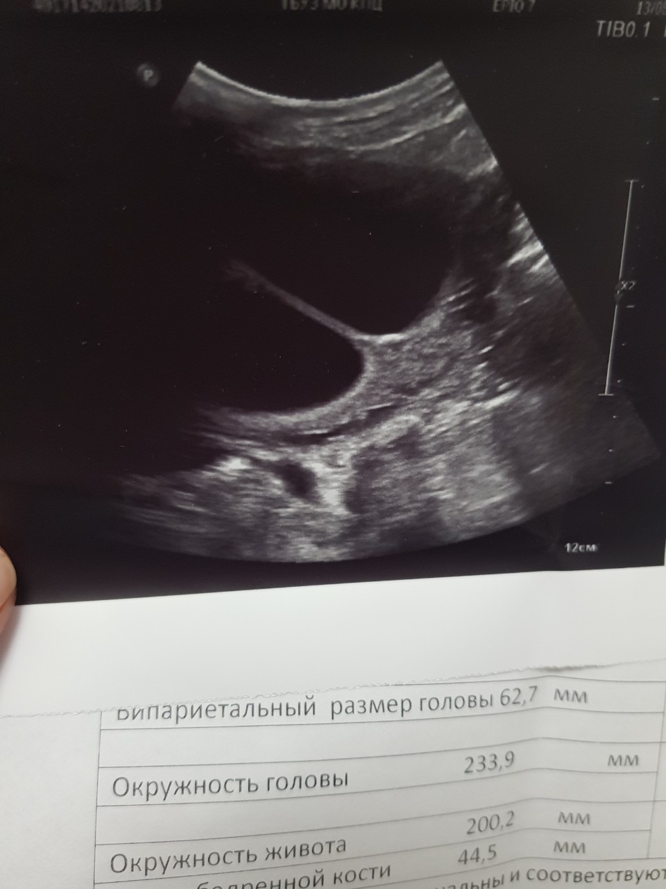Фото как выглядит матка при беременности на ранних сроках фото