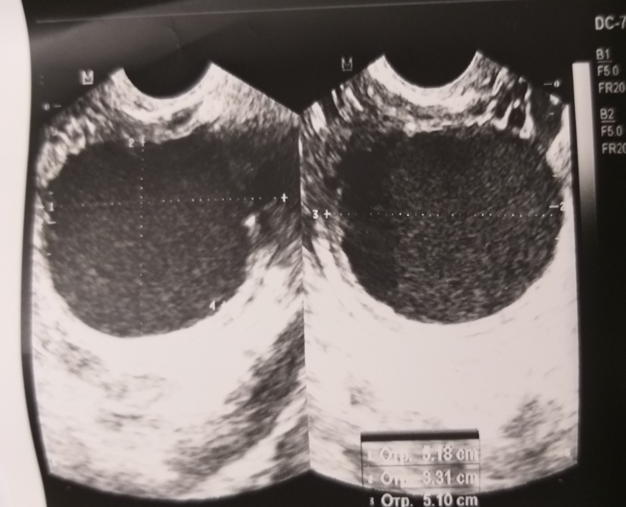 Киста 4мм. Шрамы после кисты яичника.