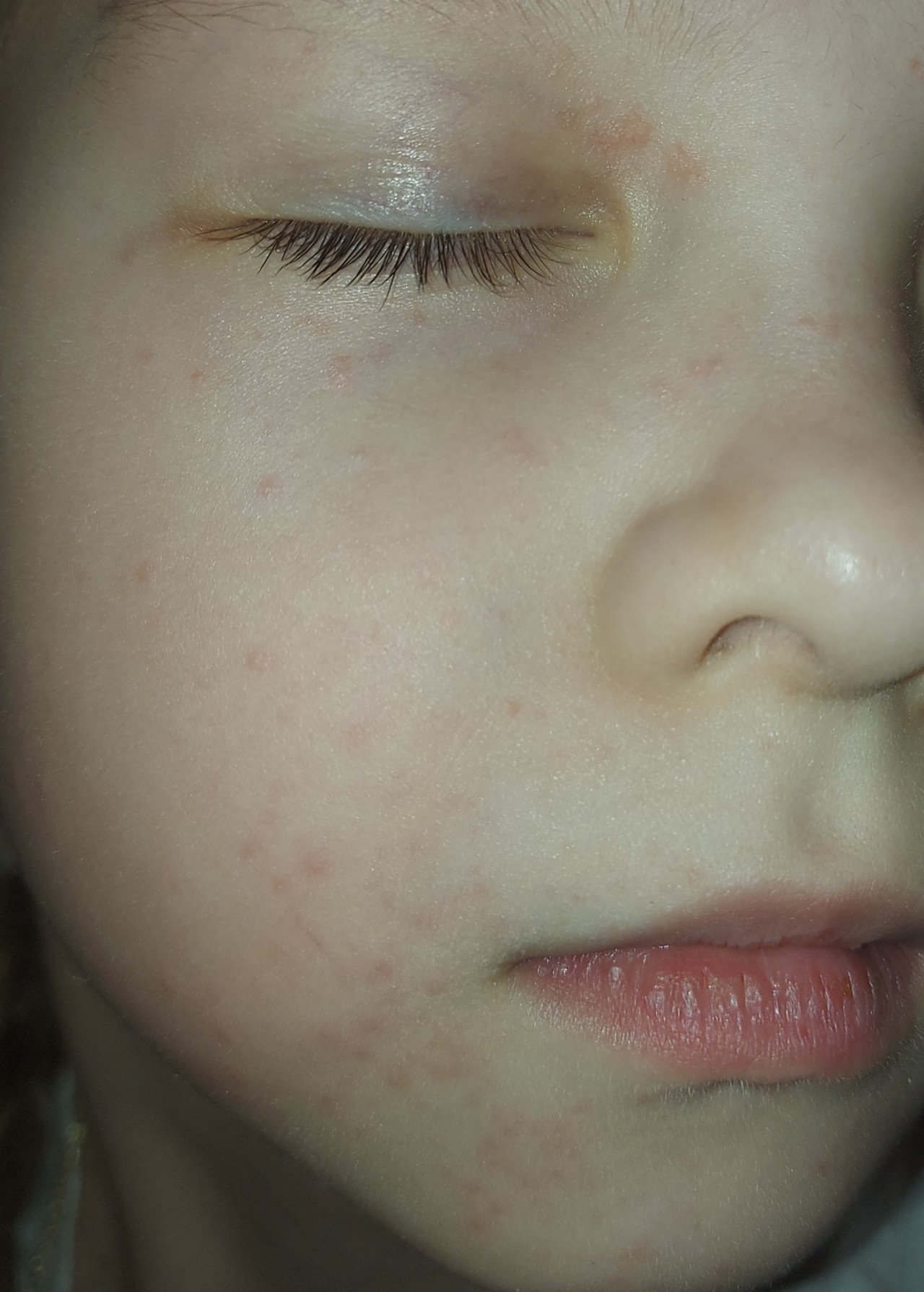 Герпетическая сыпь на лице