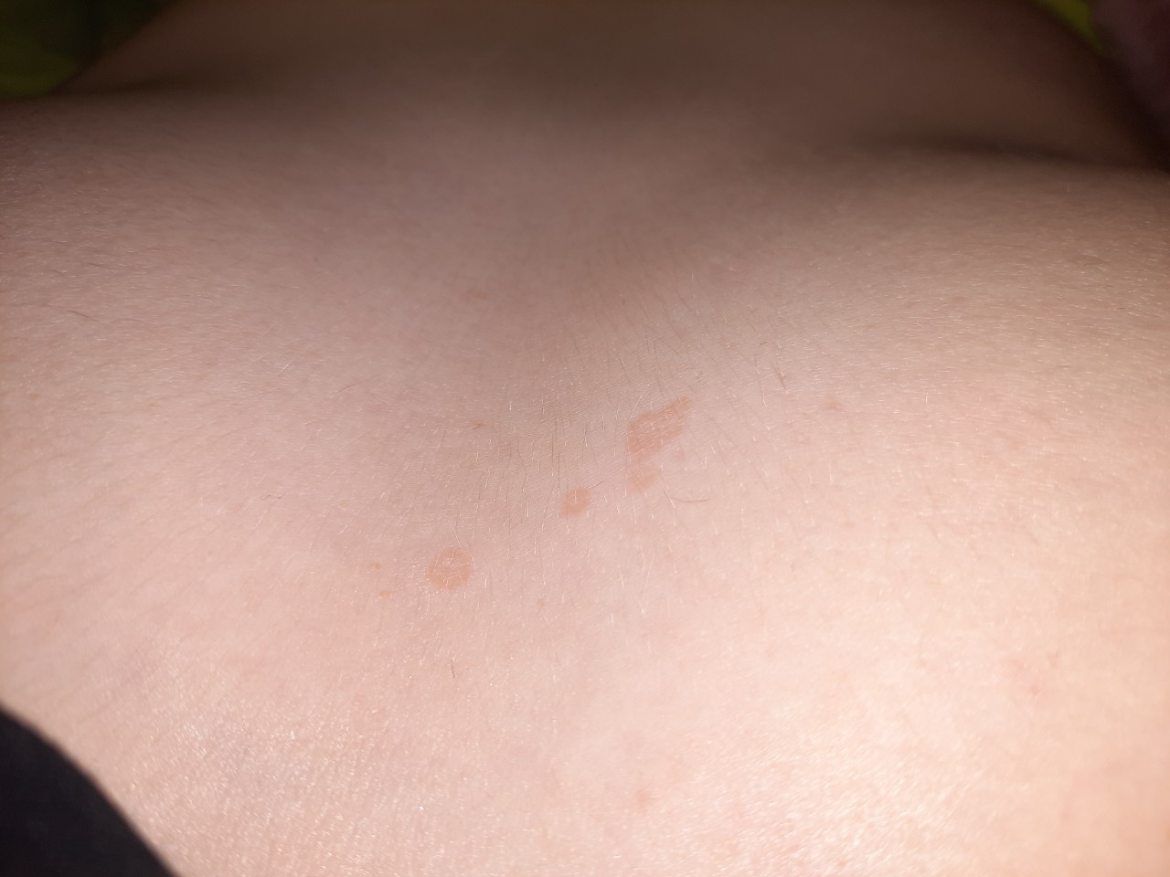 коричневые пятна на груди во время беременности фото 65