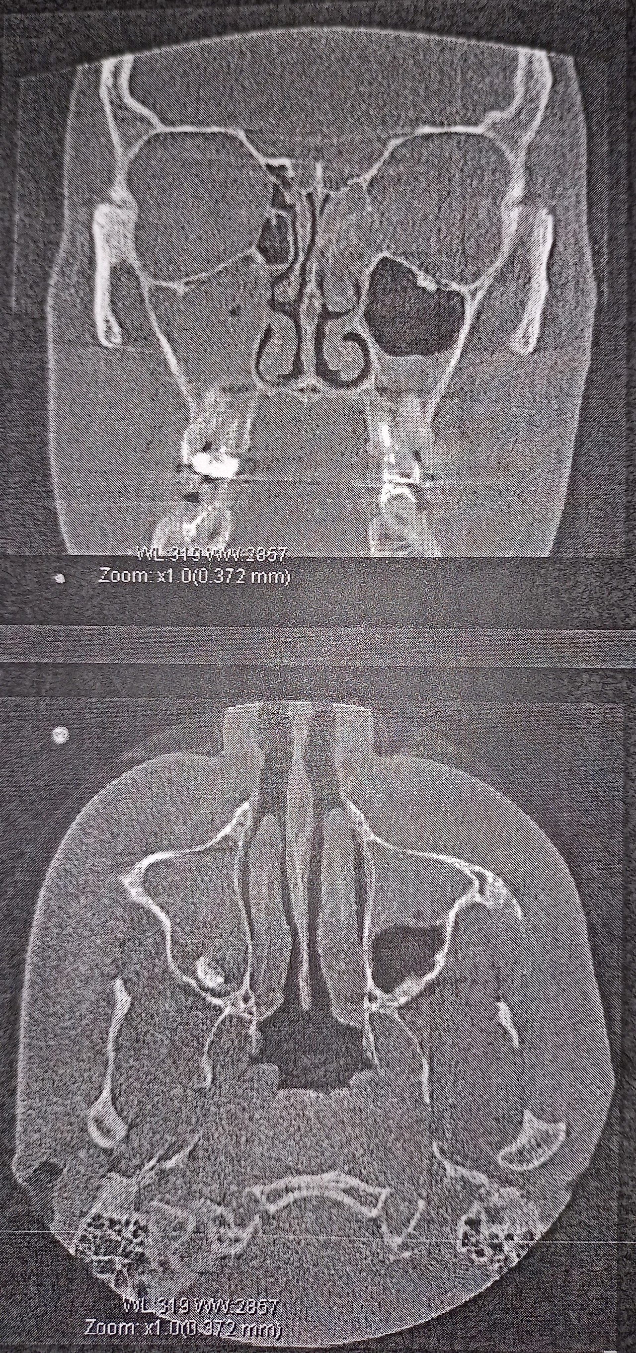 Кт носовых пазух фото