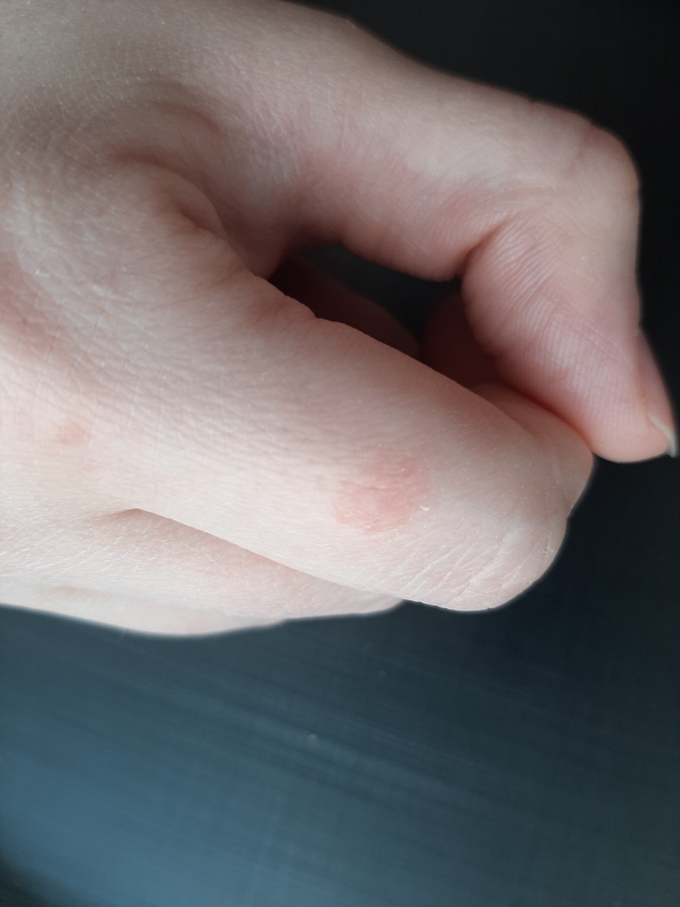 Красное шершавое пятно на пальце руки