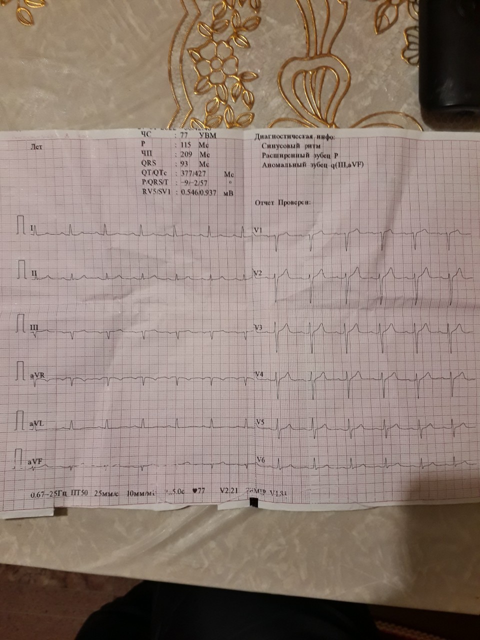 Расшифровка кардиограммы по фото