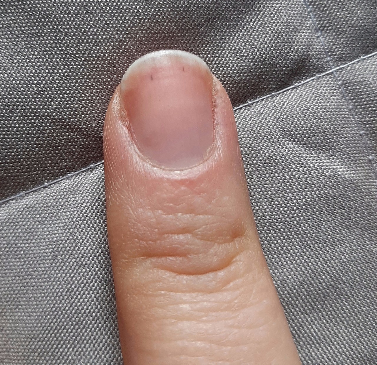  пятна на ногтях - Вопрос дерматологу - 03 Онлайн