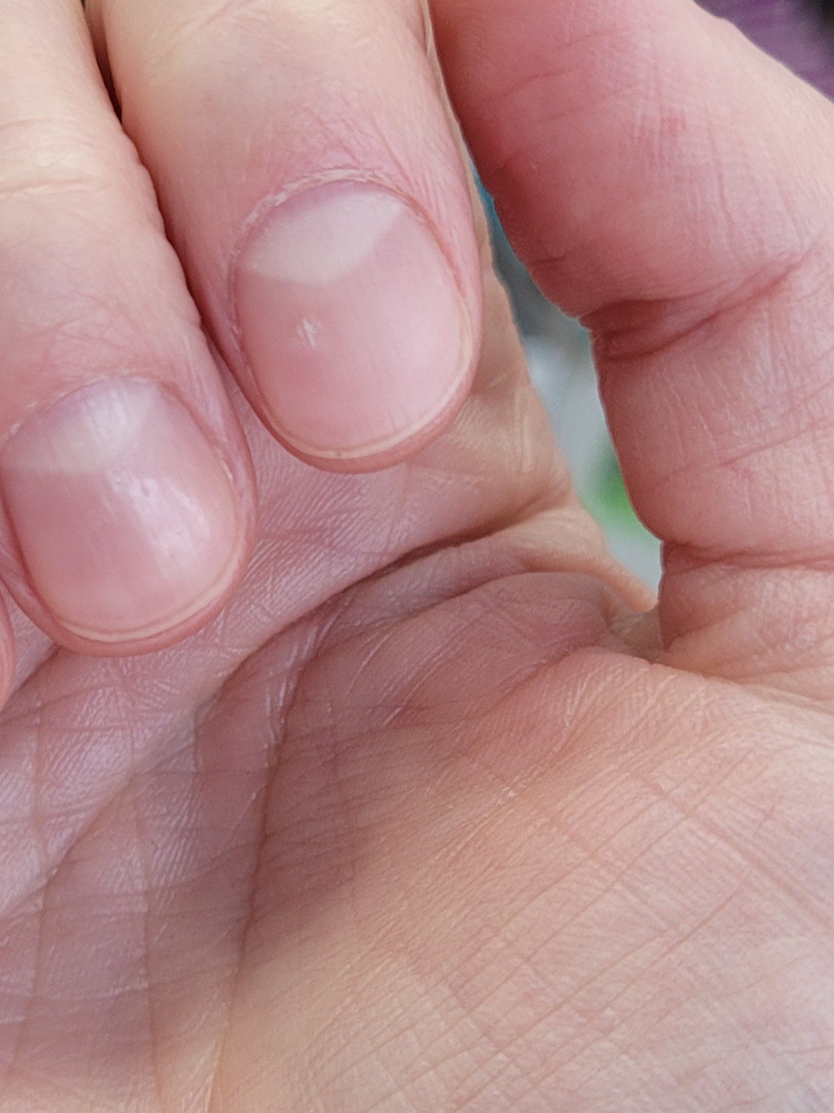 Белые вертикальные полоски на ногтях