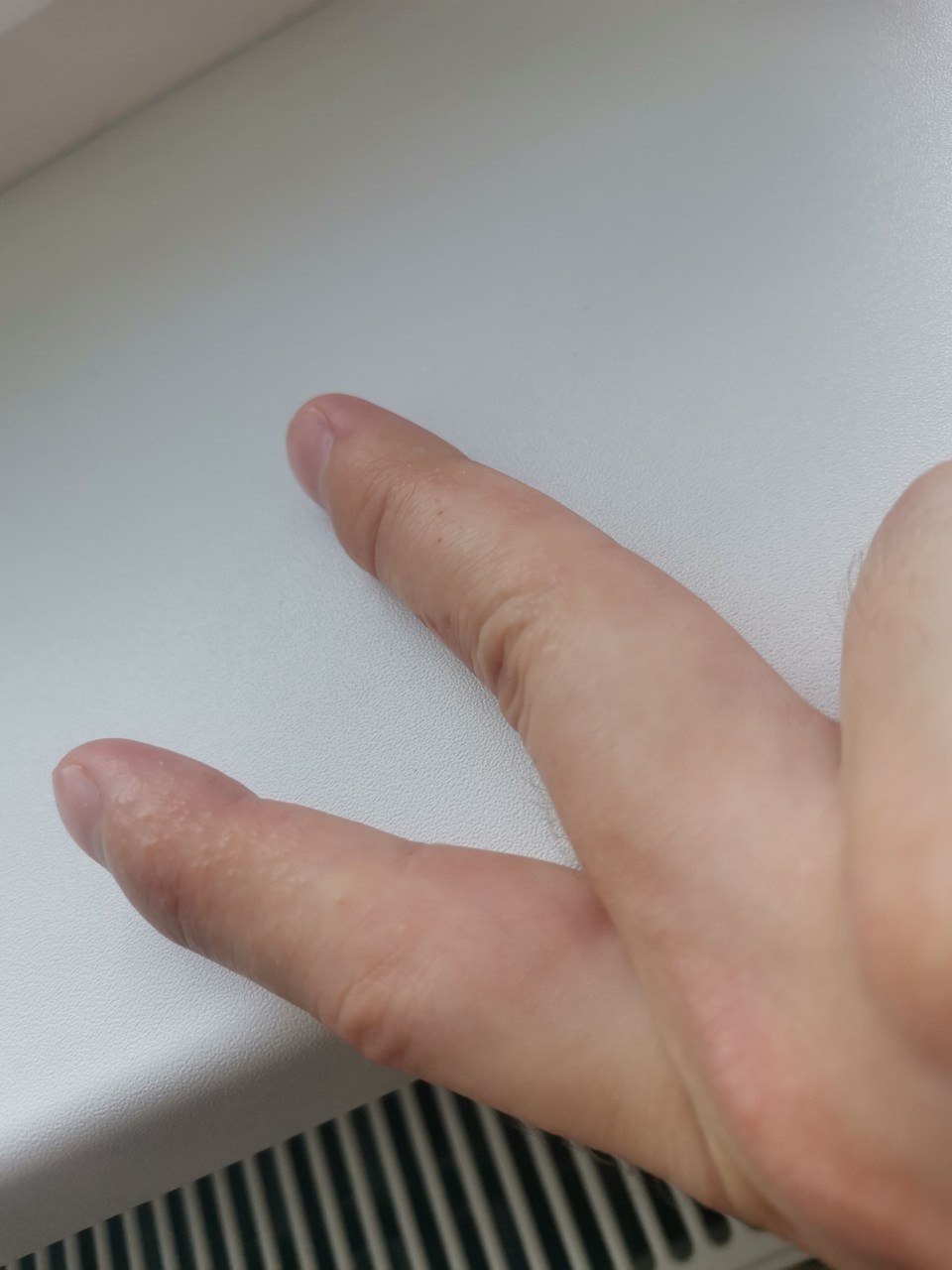 грибок между пальцев руки фото