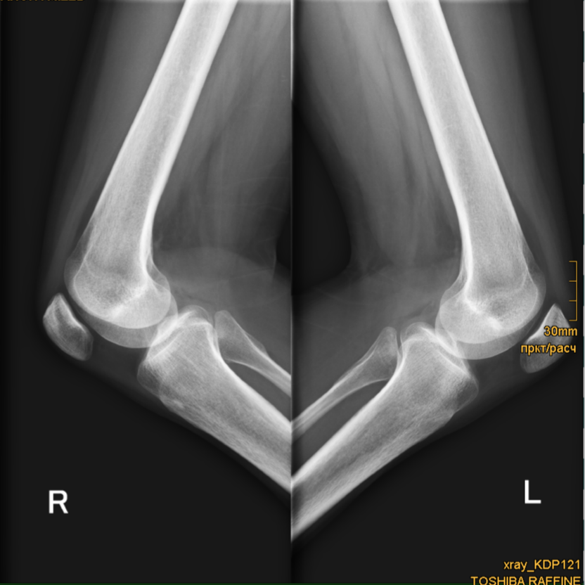 Сделать снимок коленей. Лигаментоз коленного сустава рентген. Рентгеноанатомия коленного сустава. Эпикондилит коленного сустава рентген. Вальгус коленных суставов рентген.