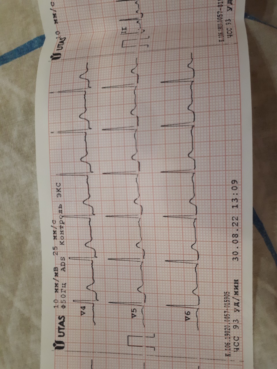 Расшифровка кардиограммы сердца онлайн по фото