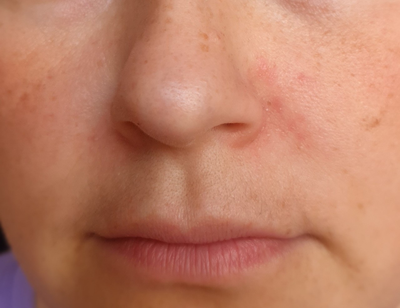 Покраснение и шелушение кожи у носа