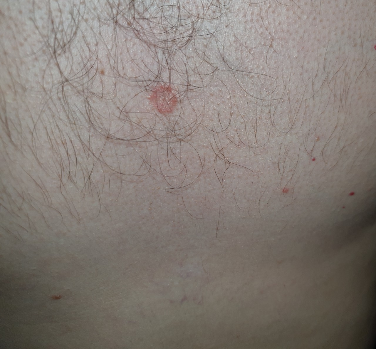 красное уплотнение на груди у мужчин фото 5