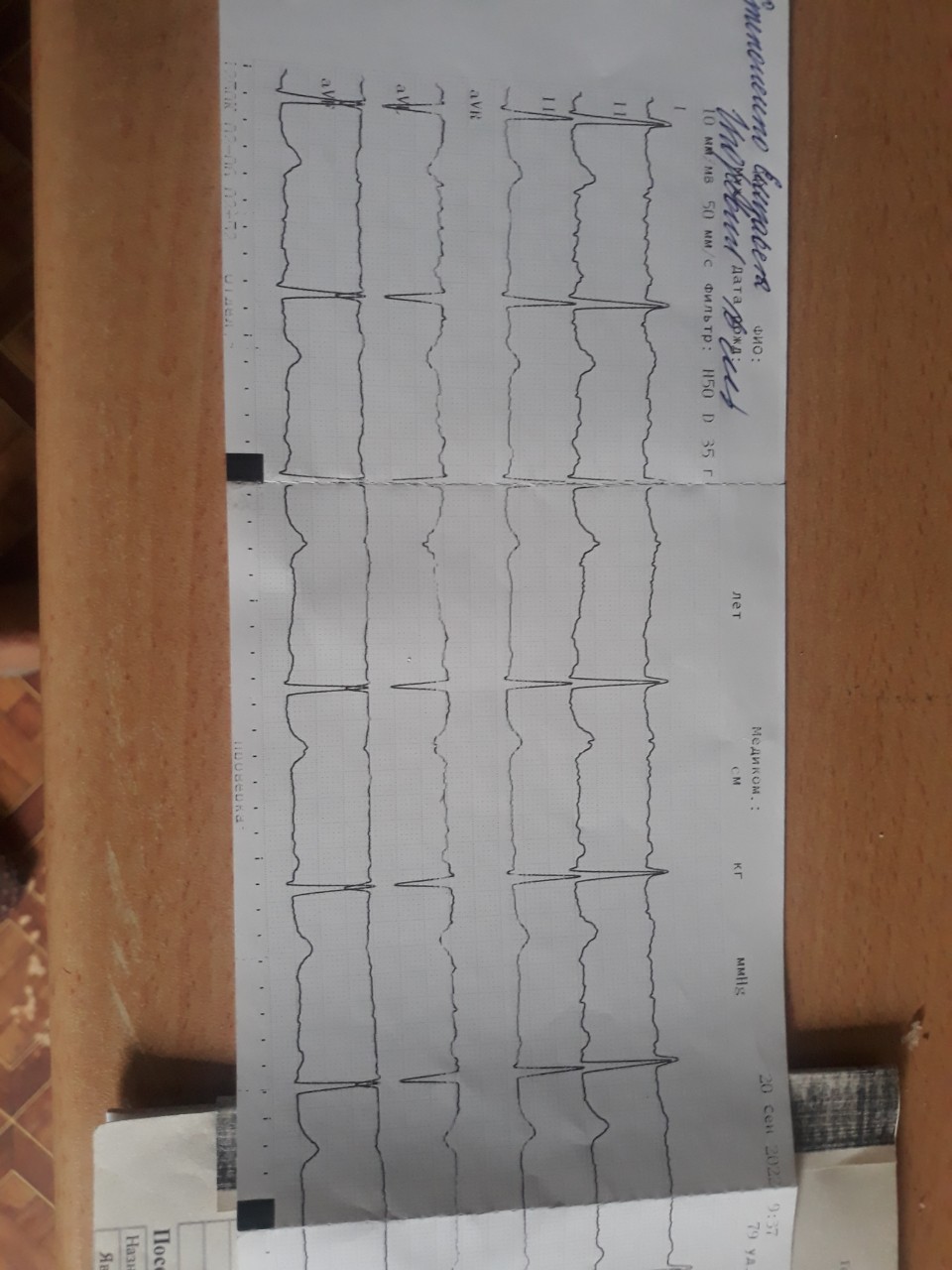 Плохая кардиограмма сердца у взрослого фото