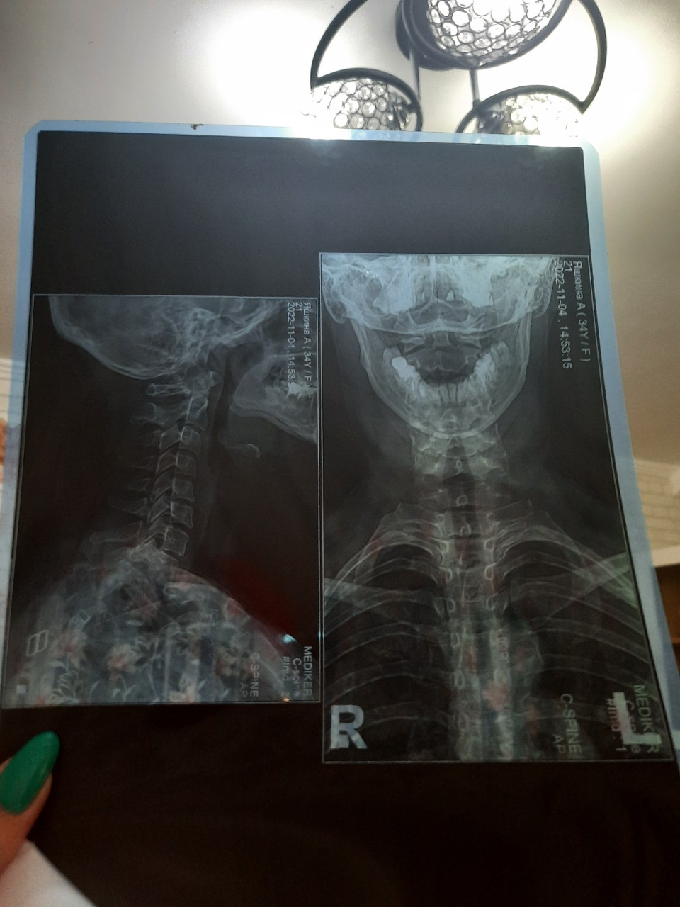 Рентген шеи фото сбоку