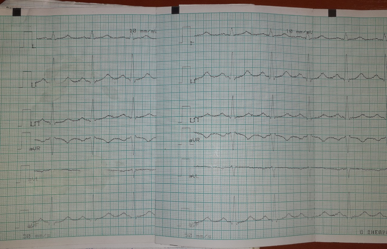 Нормальная кардиограмма фото