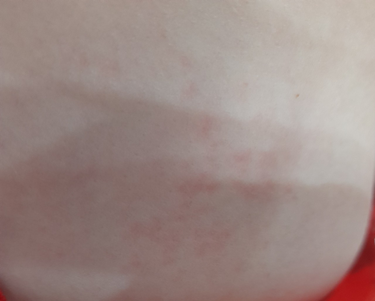 аллергия на груди у беременной фото 10