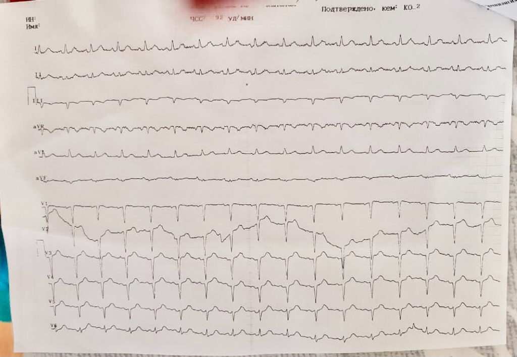 Расшифровка кардиограммы сердца по фото