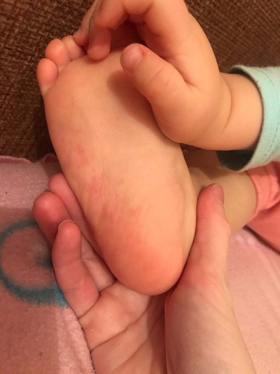 Сыпь на подошвах ног у детей
