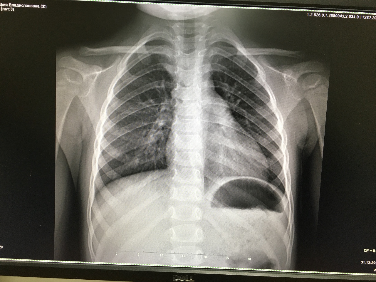 Рентгена 3. Снимок легких ребенка. Рентген здоровых легких у ребенка. Рентгенограмма лёгких дети.
