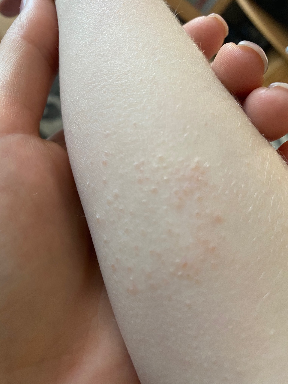аллергия на поролон в диване
