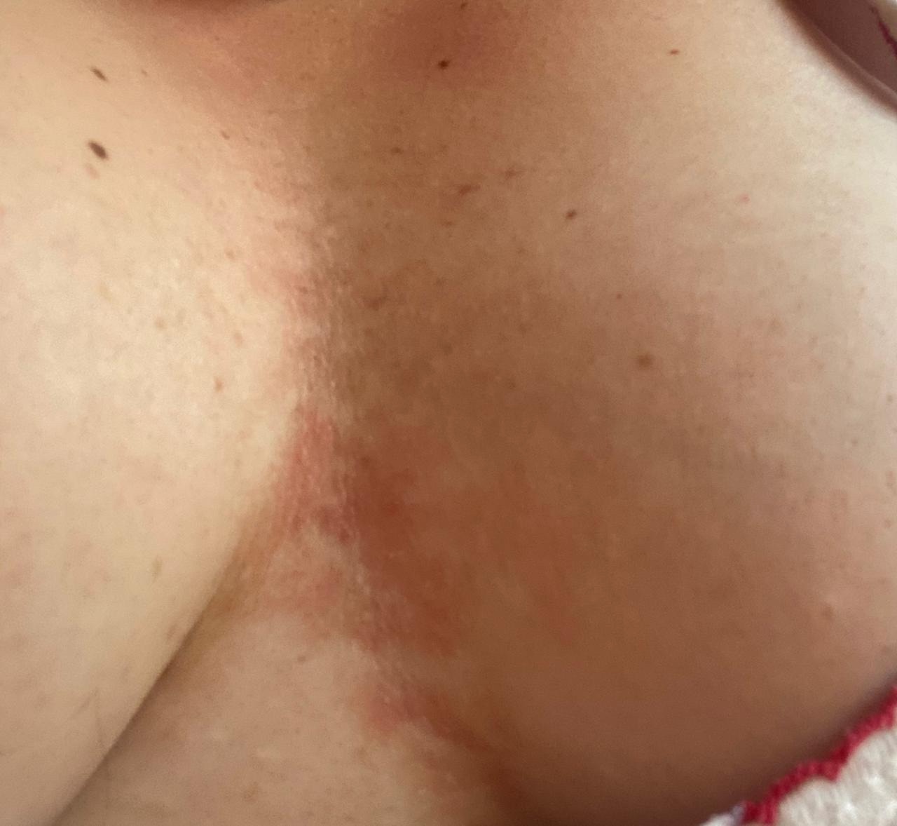 сыпь между грудей у женщин фото 10
