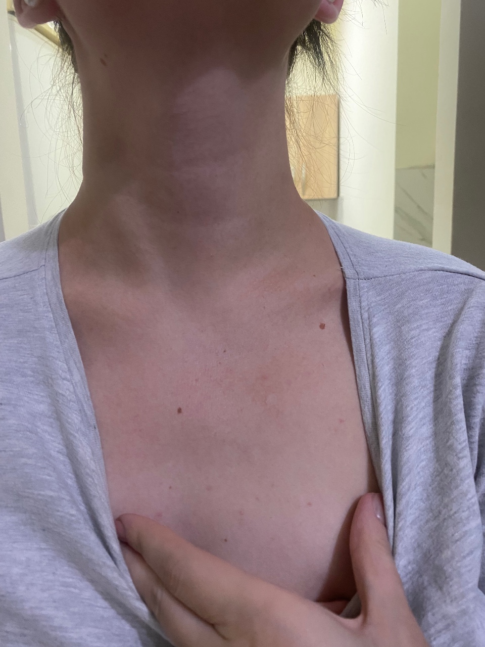 светлые пятна на груди женщин фото 106