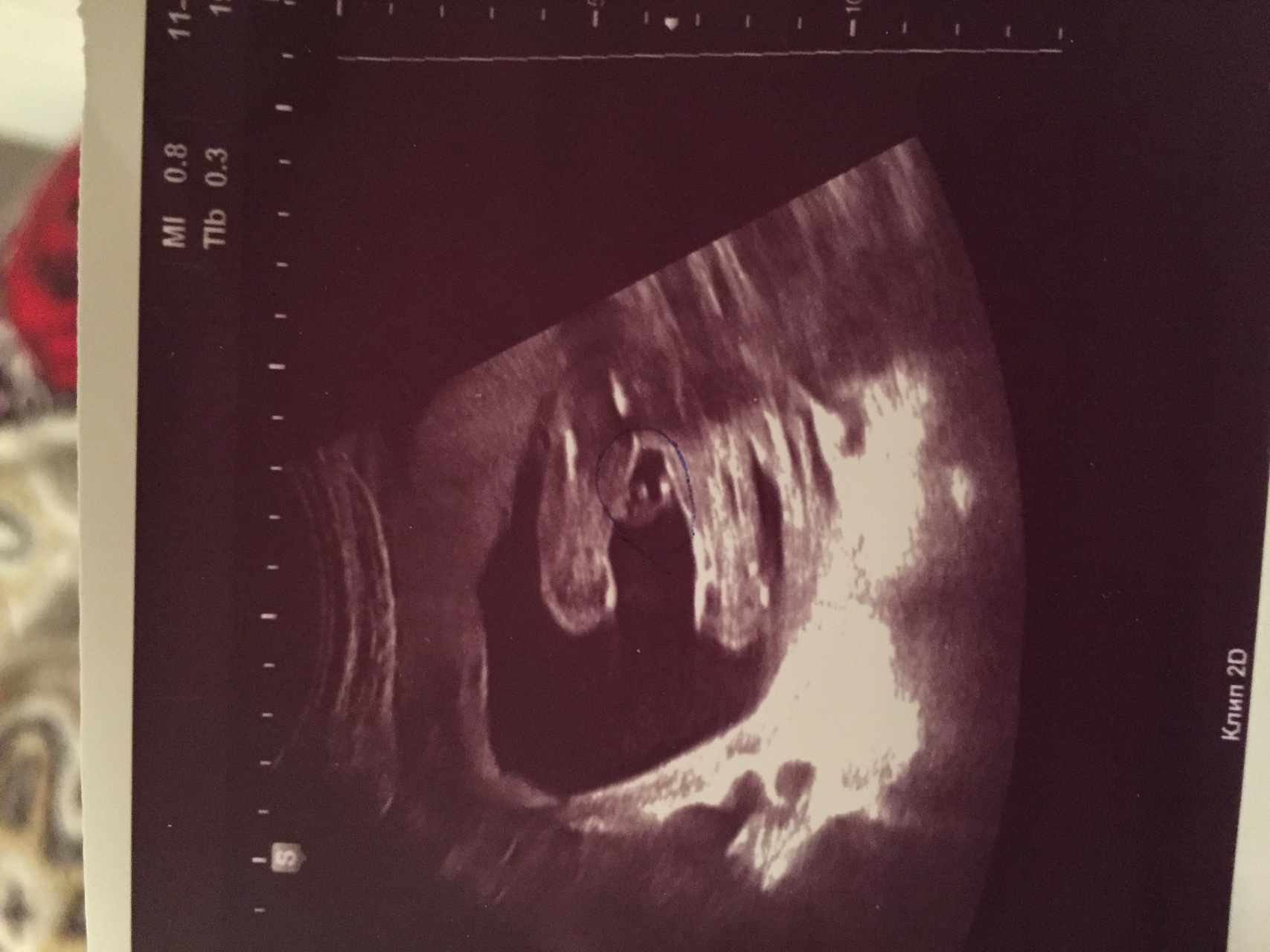 Видео УЗИ. 20 недель беременности. Пол ребенка.