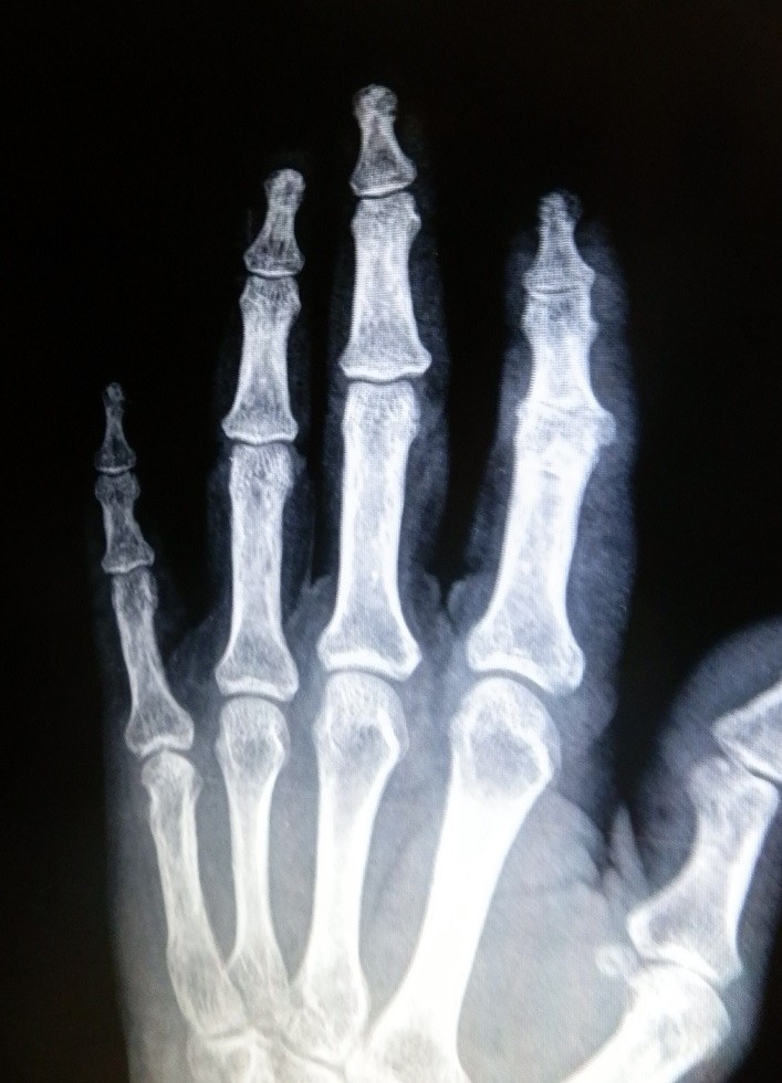 Открытый перелом фаланги. Остеомиелит пястной кости. Внутрисуставной перелом фаланги пальца рентген. Перелом фаланги мизинца рентген. Краевой перелом ногтевой фаланги пальца руки.