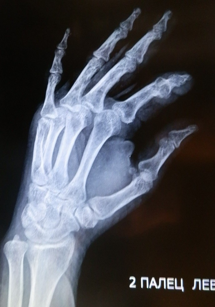 Перелом фаланги пальца на руке фото