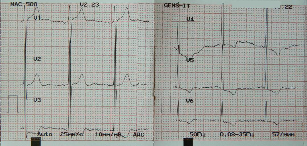 Кардиограмма сердца с инфарктом фото