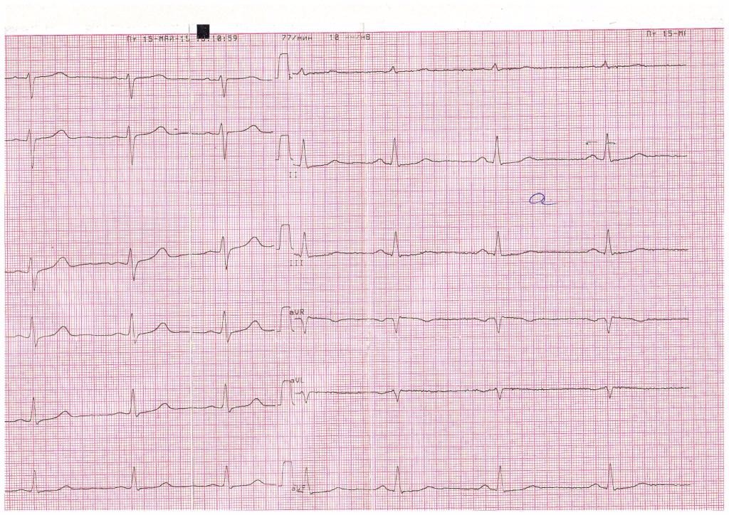 Нормальная кардиограмма сердца фото у взрослого фото