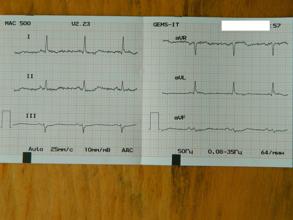 Расшифровка кардиограммы по фото