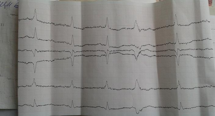 Кардиограмма при инсульте фото