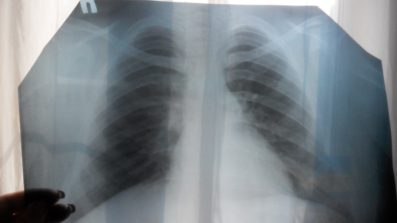Больные туберкулезом фото до и после