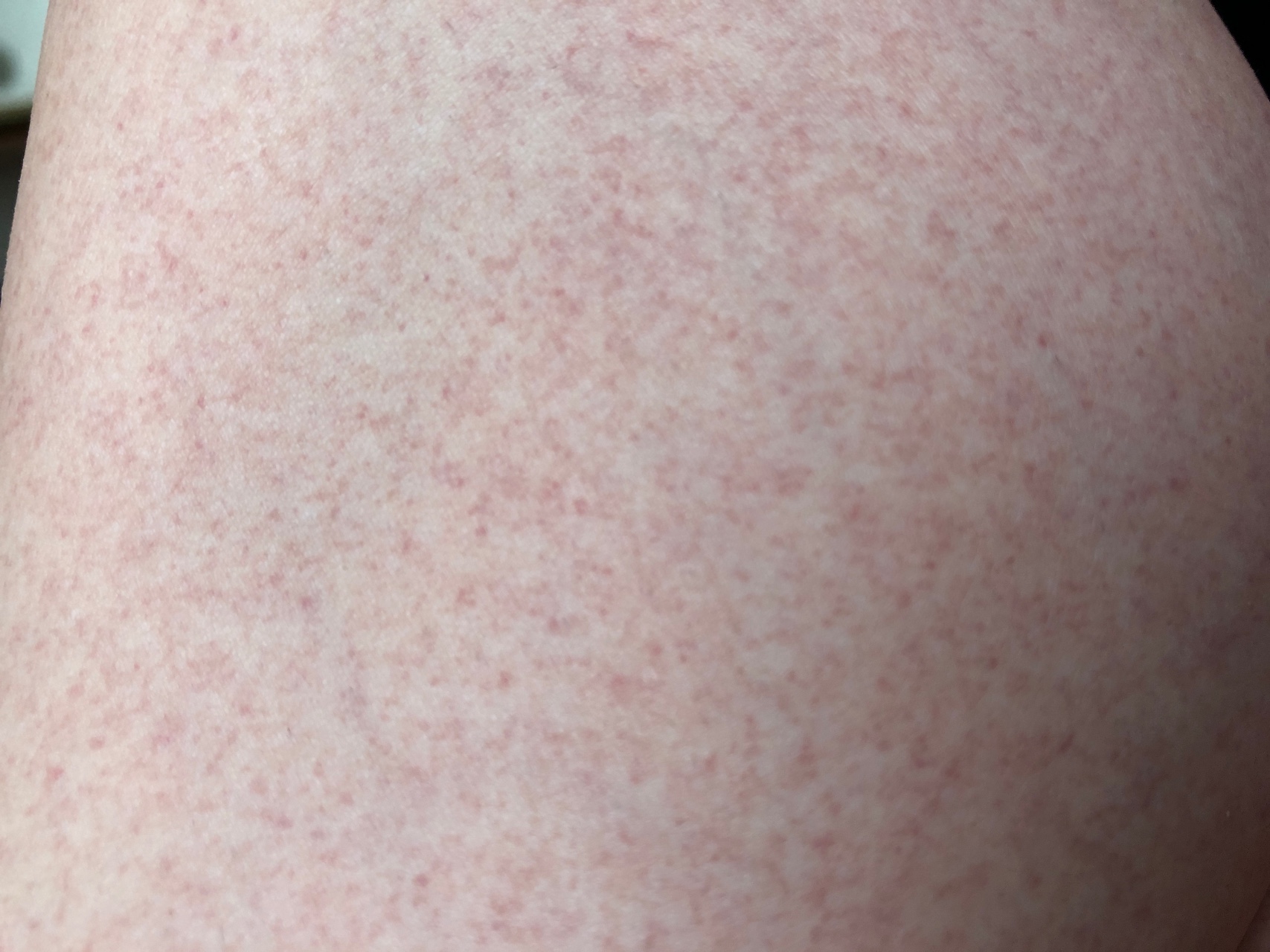 Как ухаживать за кожей после солярия. Что делать если покраснела кожа?