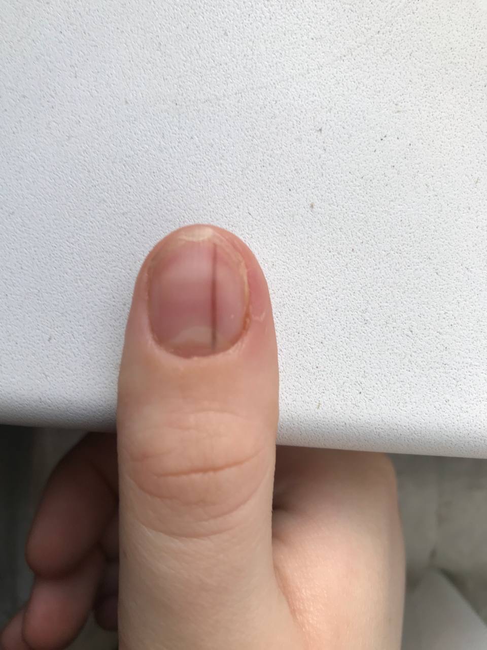 Коричневые полоски на ногтях